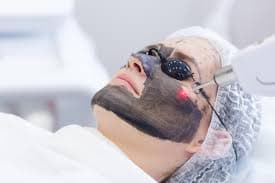 ليزر كربوني لنضارة الوجه+ تشقير وجه